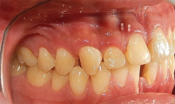Fig. 3 Intraoral derecha