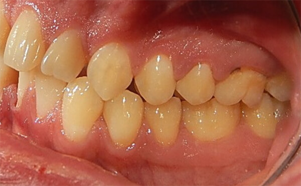 Fig. 4 Intraoral izquierda
