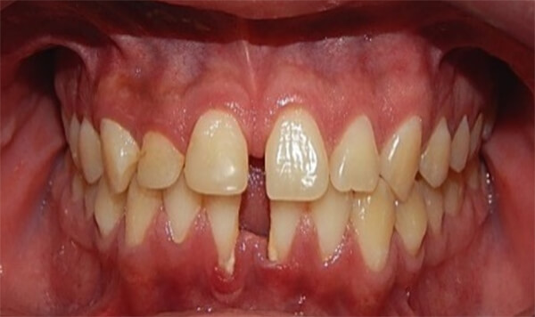Fig. 5. Intraoral de frente