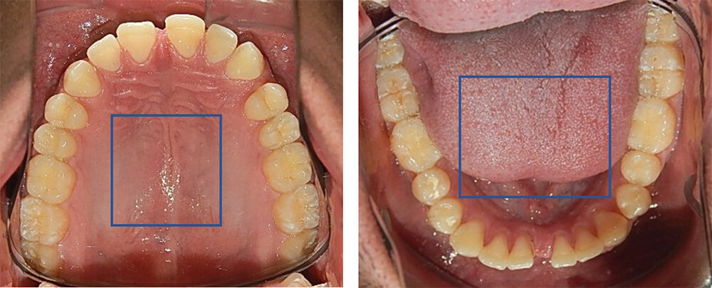 Fig. 6 Vista Oclusal superior e inferior