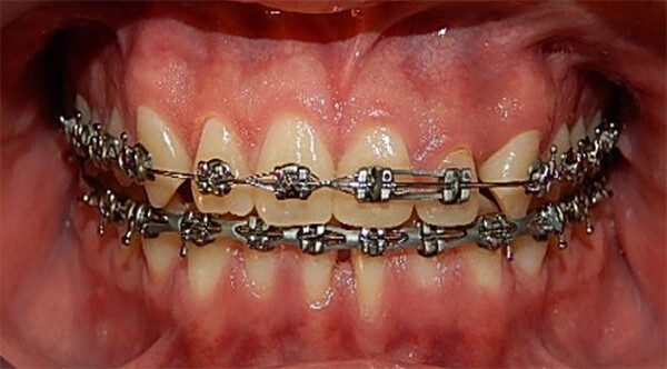 Fig.11 intraoral de frente