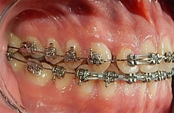Fig.9 Lateral derecha