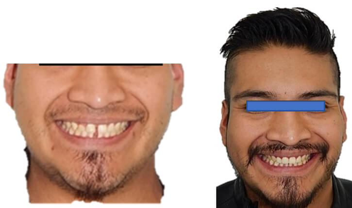 Fig.13 Sonrisa inicio, final