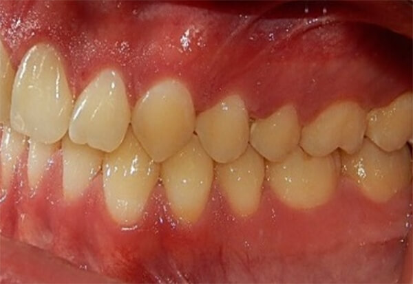 Fig.15 izquierda