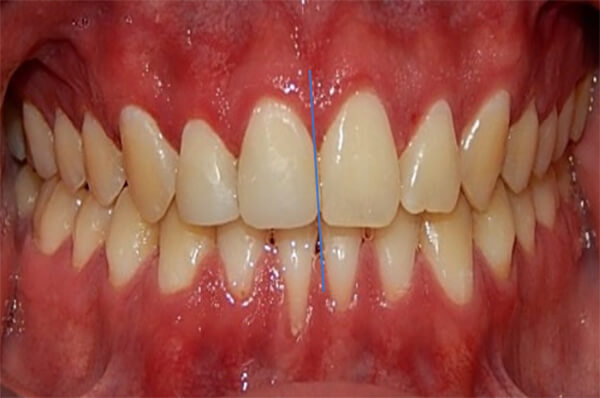 Fig.16 de frente
