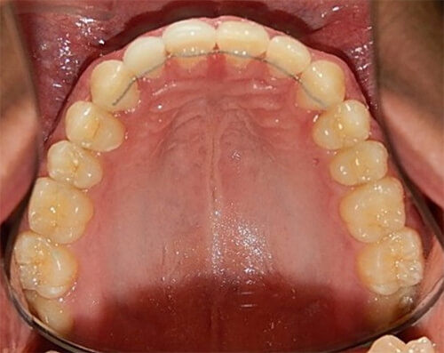 Fig.17 Oclusal superior