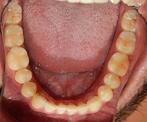 Fig.18 Oclusal inferior