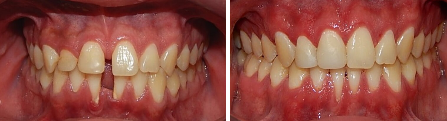 Fig.19 comparacion Intraoral de frente inicio-final