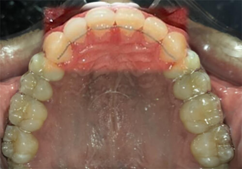 Fig. 20 Retenedor superior