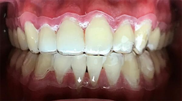 Fig.22 intraoral de frente