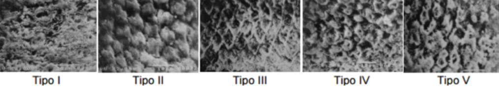 Fig. 1. Tipos de grabado en esmalte dental. Tomado de Meléndez y cols. 20029