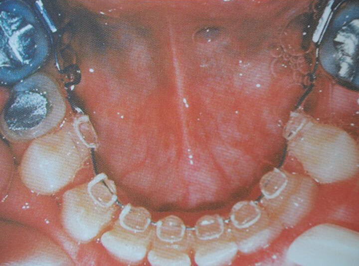 Fig. 1: Aparatología lingual de Kurz, C. Lingual Orthodontics Curse of Syllabus. Boston 1996.