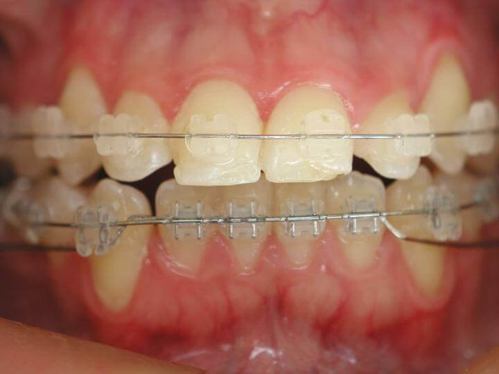 Fig. 3: Brackets Transparentes.