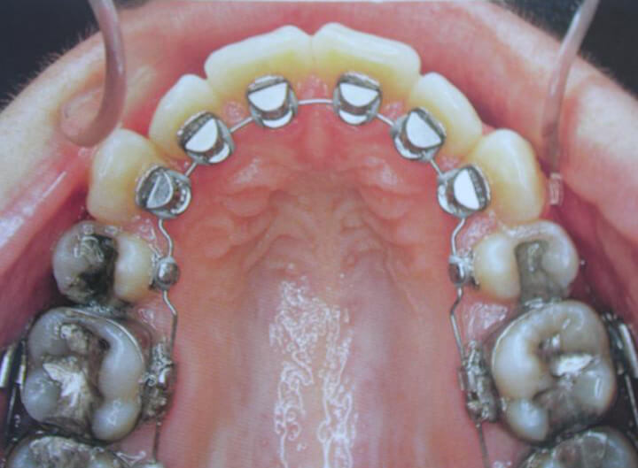 Fig. 4: 1ra Generación - Aparato Ormco/ Kurz C. Lingual Orthodontics.