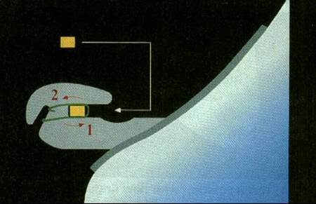 Fig. 6: Bracket Takemoto. Diseño de la ranura con inserción invertida o antero posterior.
