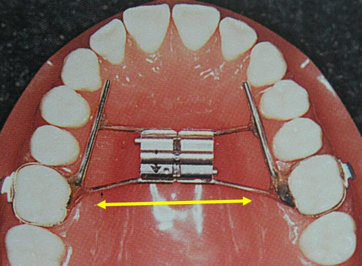 Fig. 9: La mayoría de los aparatos de expansión están diseñados para ejercer una fuerza de lingual a vestibular.