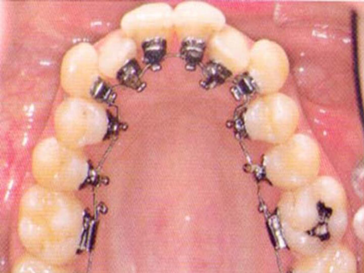 Fig. 10: Vista oclusal del arco maxilar en el momento inicial de la colocación de los brackets.