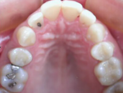 Fig. 12: Vista oclusal inicial
