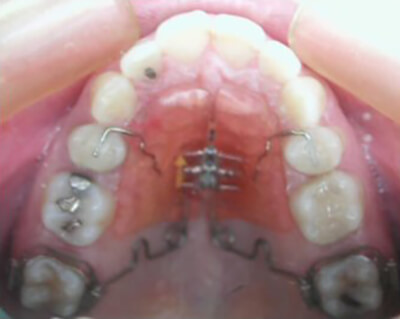 Fig.13: Vista Oclusal después de la expansión con Pendulum.