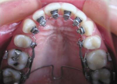 Fig. 14: Vista oclusal de los brackets, algunos meses después de su colocación Arco de acero inoxidable. 016.