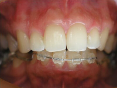 Fig. 19: Apertura de la mordida después delCementado lingual inicial. Nótese el despeje inmediato para la colocación de los brackets inferiores.