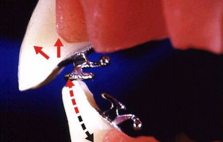 Fig.23: Efecto del plano de mordida. Al menos dos dientes deberían hacer contacto simultáneamente con el plano de mordida.Tomado de Scuzzo G, Takemoto k the Lingual orthodontics. Multimedia Manual 2001