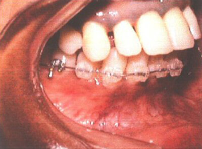 Fig. 25: Primero, arco inferior cementado Tomado de Paz, Mario E. Hands - on Lingual Course Syllabus. USA 2001