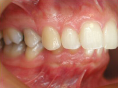 Fig. 27: La vista vestibular muestra una relación molar y canina de Clase II en el lado derecho del paciente.