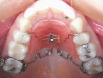 Fig.28: La vista oclusal muestra un PENDULUM, en su colocación inicial.