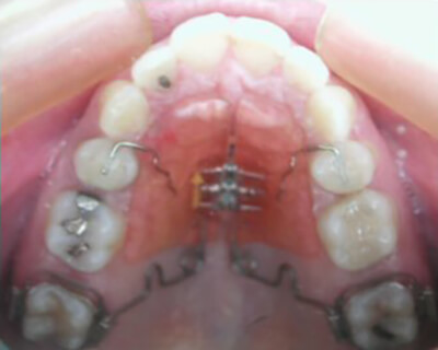 Fig. 30: La vista oclusal muestra la distalización de mordida que separa a los dientes posteriores. Después de dos meses. Los aparatos sonactivados dos veces por semana.