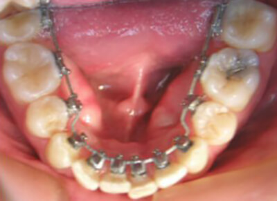 Fig. 32: Los brackets linguales permiten el tratamiento de un arco individual, cuando esto sea requerido por el paciente.