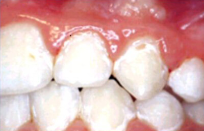 Fig. 33: Desgaste extenso del esmalte
