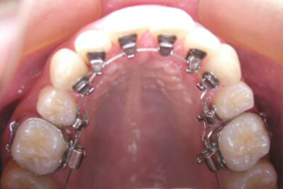 Fig. 34: Las superficies linguales permiten la colocación de brackets linguales en esta Clase de casos en las superficies labiales.