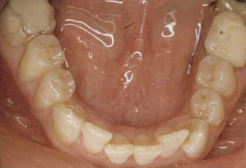 Fig. 38: Vista oclusal del arco inferior.