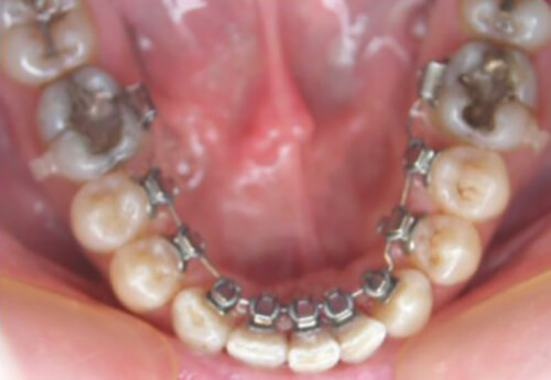 Fig. 39: Arco 016" Acero Inoxidable inferior con ansas de avance.
