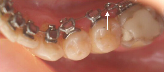 Fig: 40: Acercamiento de las ansas de avance con arco 016" de Acero Inoxidable Note el buen avance de los incisos inferiores.