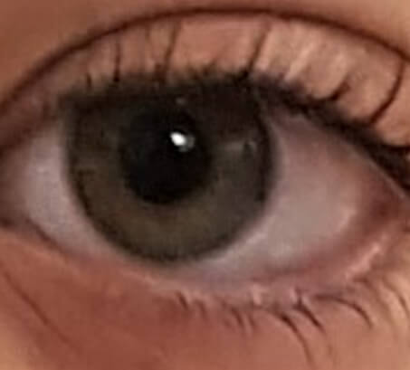Figura 3. Fotografía donde se observa iris con posibles nódulos de Lisch.