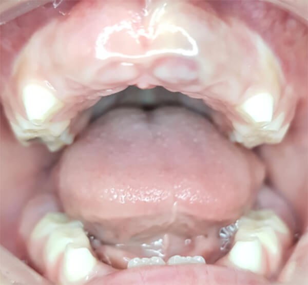 Figura 5. Fotografía Intraoral donde se observa lengua ancha.