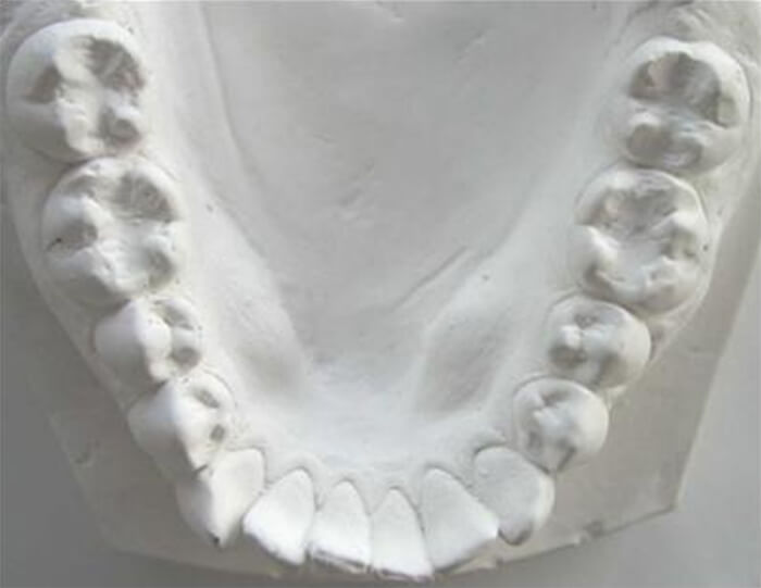 Figura. 3: Modelo de estudio inferior con apiñamiento leve
