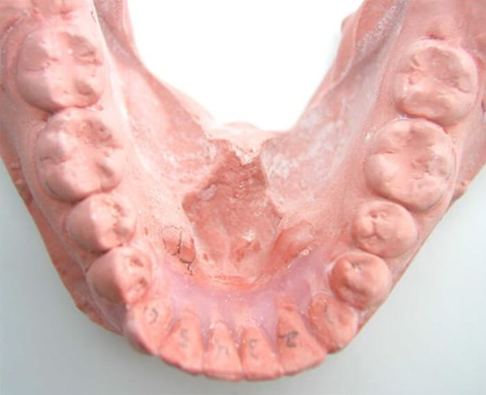 Figura. 4: Proyección en el modelo de trabajo idealizando la posición correcta de los dientes en la arcada.