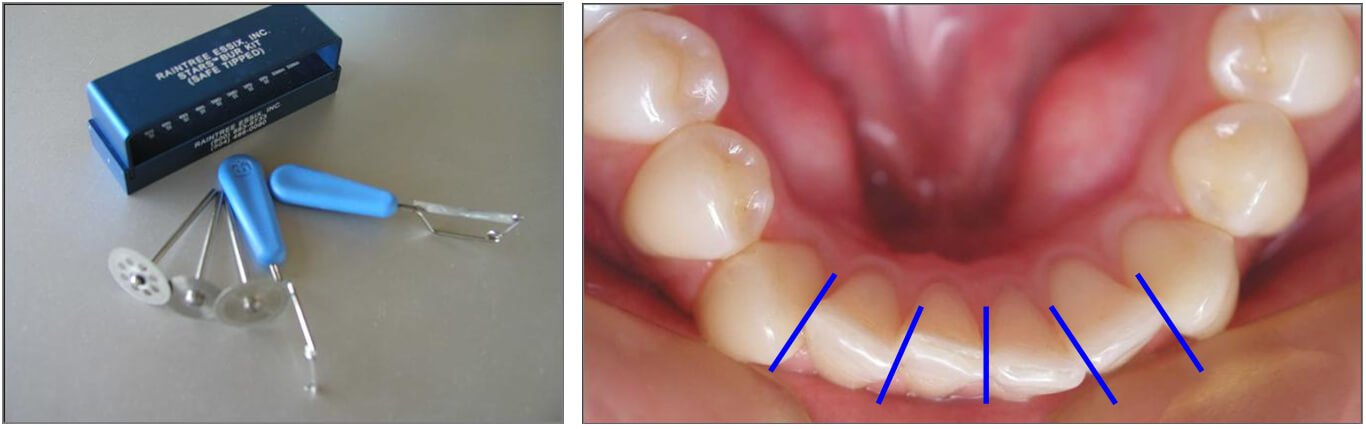Figura 8: Instrumental necesario para la realización del Remodelado proximal del esmalte