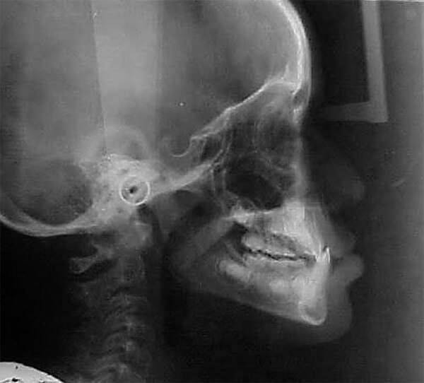Fig. 6 Radiografía lateral de cráneo inicial