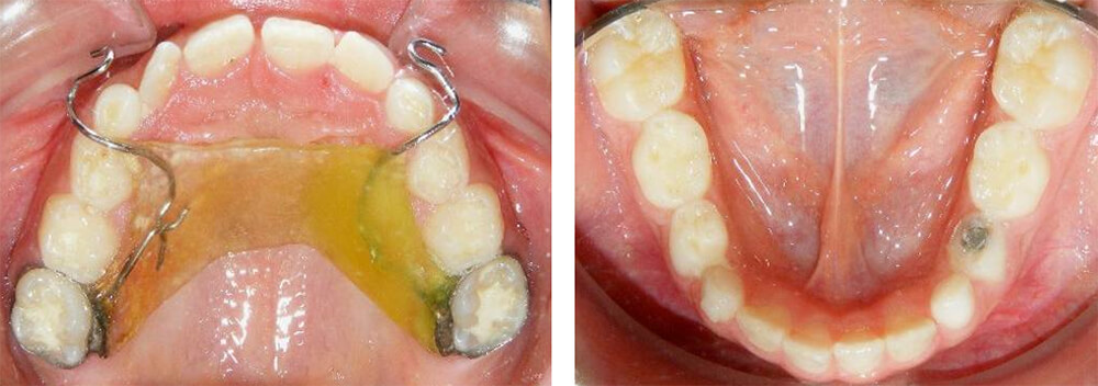 Fig. 17 Superior e inferior