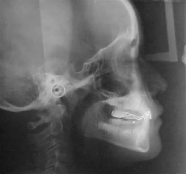 Fig. 18 Radiografía lateral de cráneo final