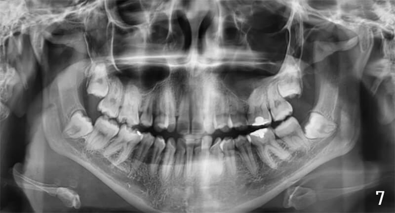 Fig. 7 Radiografía panorámica