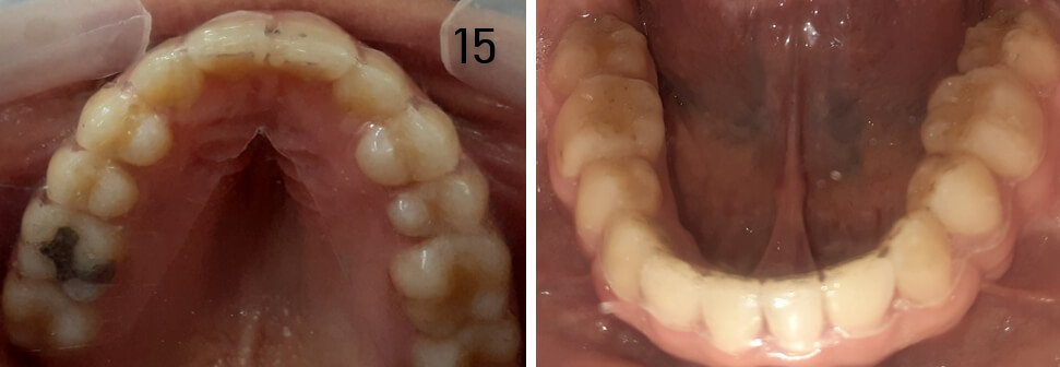 Fig. 15 Retenedores circunferencial superior e inferior