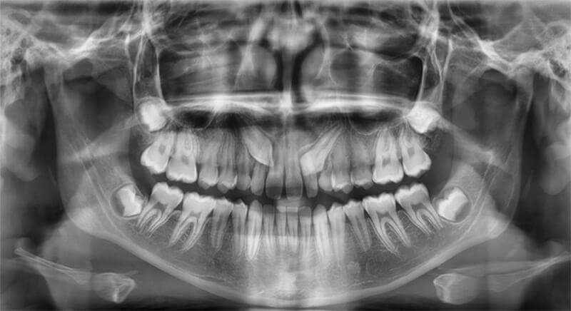 Fig. 1 Radiografía panorámica de una inclusión dentaria, su relación con las estructuras adyacentes, y dirección de caninos superiores.