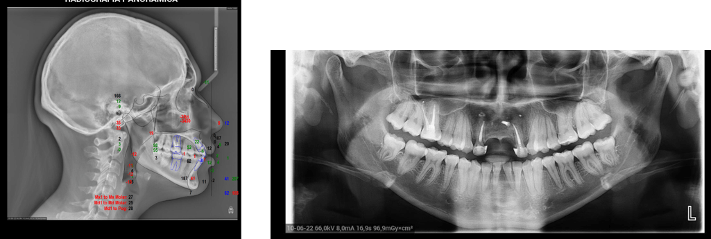 Fig 1 y 2: estudio cefalométrico de paciente sobre telerradiografía lateral de cráneo y radiografía panorámica