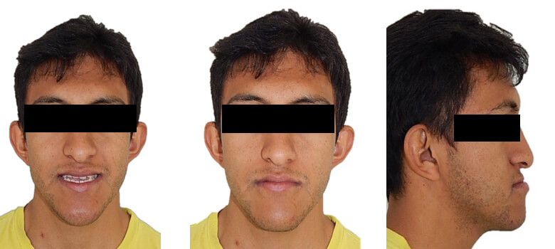 Fig 6 frente sonrisa, reposo, perfil