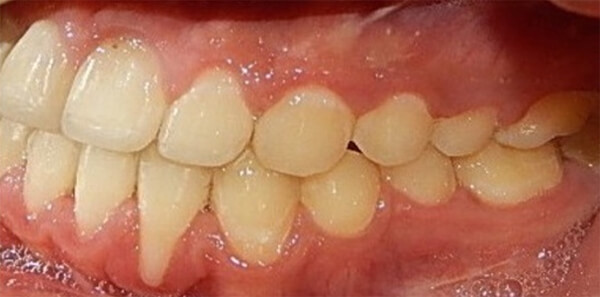 Fig 12. Lateral derecha, frente, izquierda final.